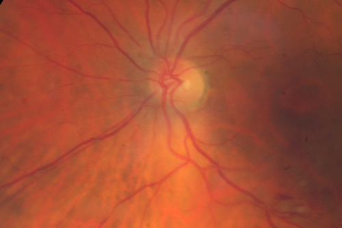 Branch Retinal Vein Occlusion
84 year old man - 2 months vision loss - VA 20/40 - 20/20 with one injection of Eylea
