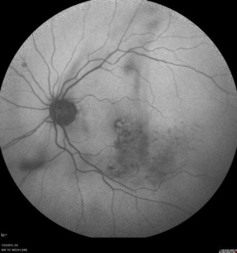 Branch Retinal Vein Occlusion
84 year old man - 2 months vision loss - VA 20/40 - 20/20 with one injection of Eylea
