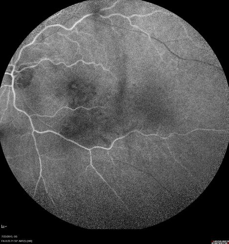 Branch Retinal Vein Occlusion
84 year old man - 2 months vision loss - VA 20/40 - 20/20 with one injection of Eylea
