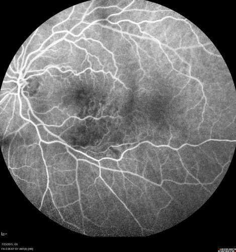 Branch Retinal Vein Occlusion
84 year old man - 2 months vision loss - VA 20/40 - 20/20 with one injection of Eylea
