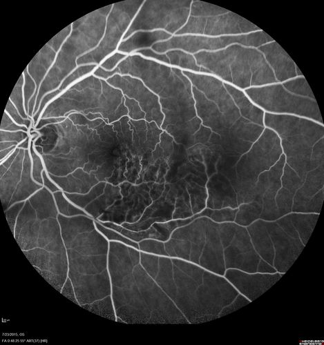 Branch Retinal Vein Occlusion
84 year old man - 2 months vision loss - VA 20/40 - 20/20 with one injection of Eylea
