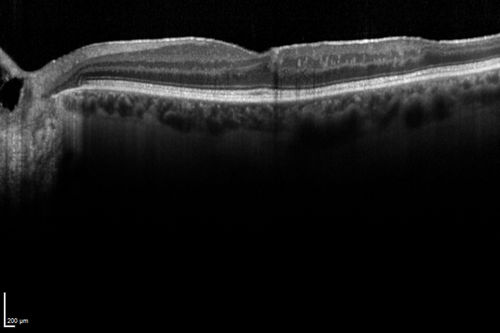 Ischemic BRVO with non-perfusion (nonperfusion) - recovered from severe vitreous hemorrhage
