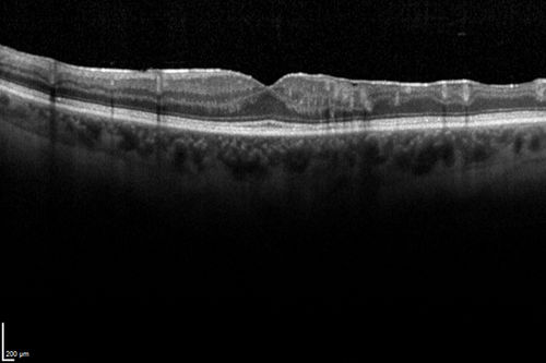 Minimal macular changes on SD OCT
Superficial and deep capillary plexus visible because of collateral vessels
