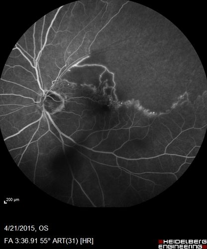 Ischemic BRVO with non-perfusion (nonperfusion) - recovered from severe vitreous hemorrhage
