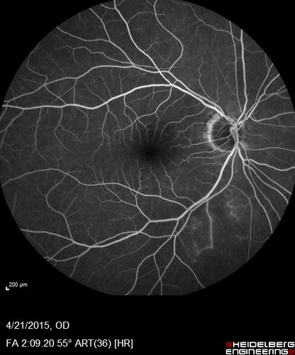 Non macular BRVO with good vision (Fellow eye has severe BRVO)
