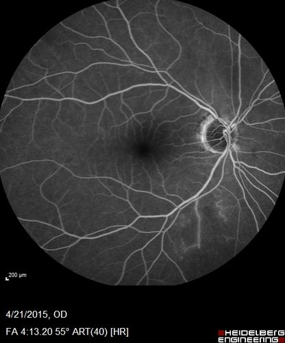 Non macular BRVO with good vision (Fellow eye has severe BRVO)
