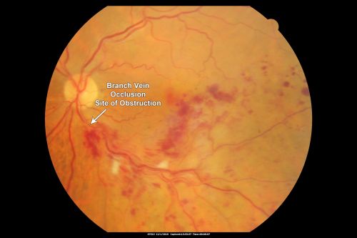Macular Branch Retinal Vein Occlusion and Adult Vitelliform Dystrophy
72-year-old woman 2 months post ECCE with poor vision since surgery especially left eye.
VISUAL ACUITY:  OD 20/50,  OS 20/200
