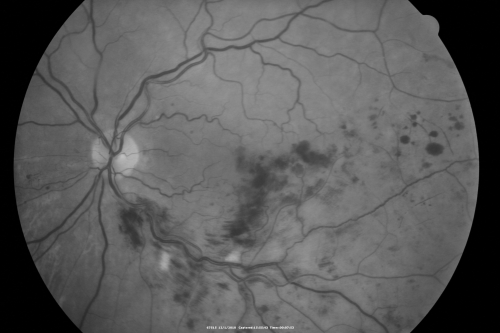 Macular Branch Retinal Vein Occlusion and Adult Vitelliform Dystrophy
72-year-old woman 2 months post ECCE with poor vision since surgery especially left eye.
VISUAL ACUITY:  OD 20/50,  OS 20/200
