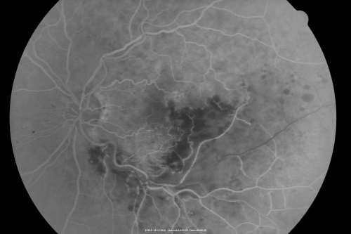 Macular Branch Retinal Vein Occlusion and Adult Vitelliform Dystrophy
72-year-old woman 2 months post ECCE with poor vision since surgery especially left eye.
VISUAL ACUITY:  OD 20/50,  OS 20/200
