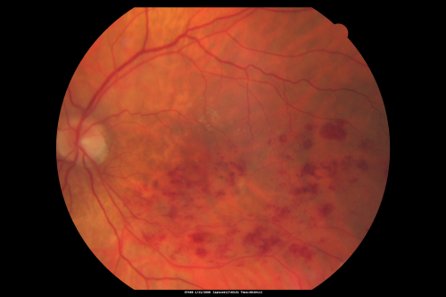 Branch Retinal Vein Occlusion with Macular Edema
Central foveal thickness came to normal after laser and intravitreal Kenalog
