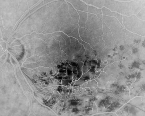 Branch Retinal Vein Occlusion with Macular Edema
Central foveal thickness came to normal after laser and intravitreal Kenalog
Keywords: best of rvo
