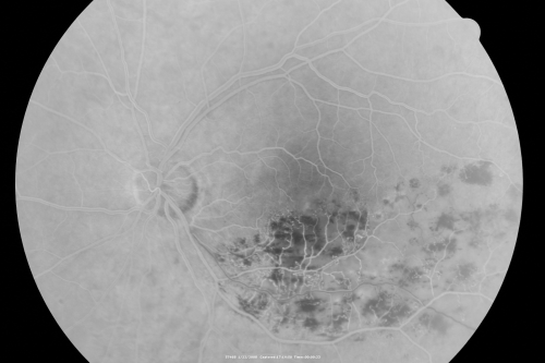 Branch Retinal Vein Occlusion with Macular Edema
Central foveal thickness came to normal after laser and intravitreal Kenalog
