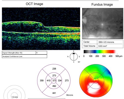 Branch Retinal Vein Occlusion with Macular Edema
Central foveal thickness came to normal after laser and intravitreal Kenalog
