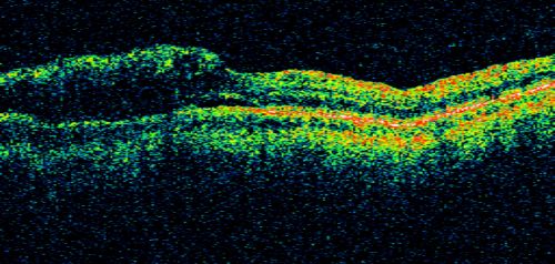 Branch Retinal Vein Occlusion with Macular Edema
Central foveal thickness came to normal after laser and intravitreal Kenalog
