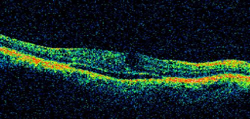 Branch Retinal Vein Occlusion with Cotton Wool Spot 
70-year-old man with blurred vision in the right eye for about one or two months. OD is 20/80, OS is 20/25.
