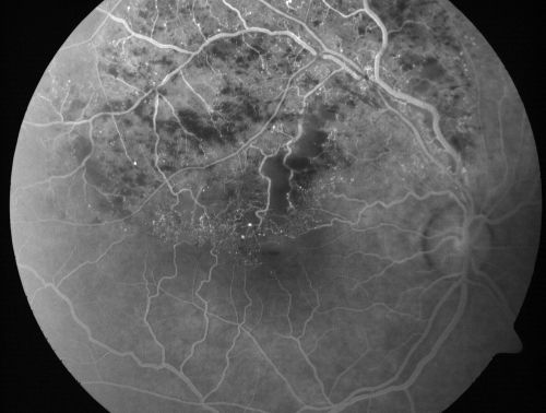 Branch Retinal Vein Occlusion with Cotton Wool Spot 
70-year-old man with blurred vision in the right eye for about one or two months. OD is 20/80, OS is 20/25.
