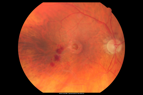 New BRVO Left Eye Old BRVO Right Eye  - Right Eye Showing Bulls Eye Atrophy from Chronic CME and Non-Perfusion Infero-temporally
90-year-old man decreased vision maybe one year since cataract surgery he is no longer able to read. OD 20/200,  OS 20/200
