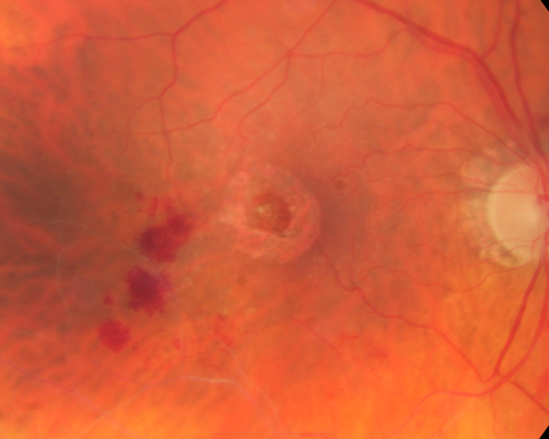 New BRVO Left Eye Old BRVO Right Eye  - Right Eye Showing Bulls Eye Atrophy from Chronic CME and Non-Perfusion Infero-temporally
90-year-old man decreased vision maybe one year since cataract surgery he is no longer able to read. OD 20/200,  OS 20/200
