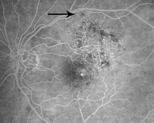 New BRVO Left Eye Old BRVO Right Eye  - Left Eye Shows Twig Superior Vein Occlusion with Edema  Arrow Shows Site of Occlusion
90-year-old man decreased vision maybe one year since cataract surgery he is no longer able to read. OD 20/200,  OS 20/200
