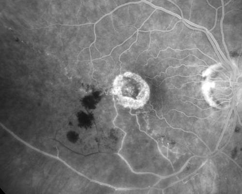 New BRVO Left Eye Old BRVO Right Eye  - Right Eye Showing Bulls Eye Atrophy from Chronic CME and Non-Perfusion Infero-temporally
90-year-old man decreased vision maybe one year since cataract surgery he is no longer able to read. OD 20/200,  OS 20/200
