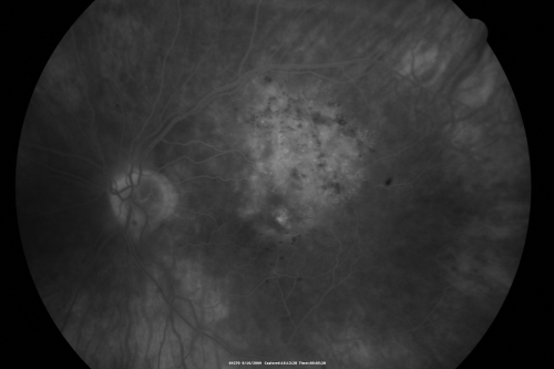 New BRVO Left Eye Old BRVO Right Eye - Left Eye Shows Twig Superior Vein Occlusion with Edema
90-year-old man decreased vision maybe one year since cataract surgery he is no longer able to read. OD 20/200,  OS 20/200

