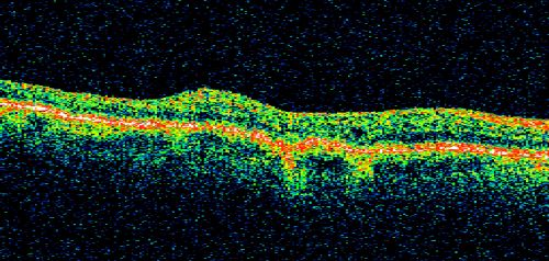 New BRVO Left Eye Old BRVO Right Eye  - Right Eye Showing Bulls Eye Atrophy from Chronic CME and Non-Perfusion Infero-temporally
90-year-old man decreased vision maybe one year since cataract surgery he is no longer able to read. OD 20/200,  OS 20/200
