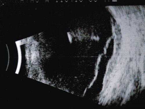 Choroidal Melanoma - Exudative Retinal Detachment 82 Year Old Man B Scan Ultrasound Longitudinal
82-year-old man who had 3 falls 2 weeks ago. After the falls he started checking his vision and noticed there was a veil over the left eye, which he had seen for about two weeks in the superior visual field.  OD 20/25,  OS 20/40
(patient was medically never well enough for brachytherapy and died 6 months later from heart disease) 
