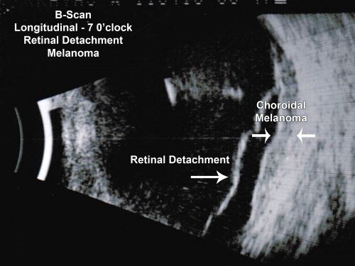 Choroidal Melanoma - Exudative Retinal Detachment 82 Year Old Man B Scan Ultrasound Longitudinal
82-year-old man who had 3 falls 2 weeks ago. After the falls he started checking his vision and noticed there was a veil over the left eye, which he had seen for about two weeks in the superior visual field.  OD 20/25,  OS 20/40
(patient was medically never well enough for brachytherapy and died 6 months later from heart disease) 
