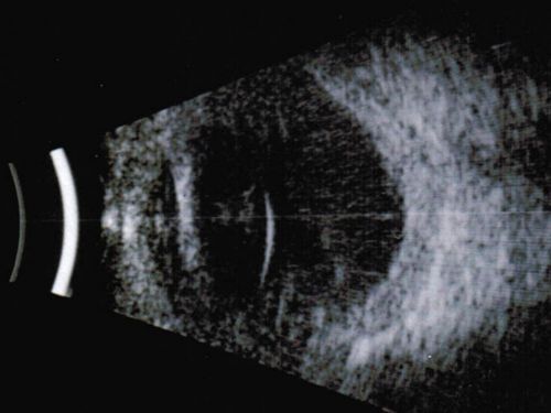 Nanopthalmous (Microphthalmous) Chorioretinal Folds and Choroidal Thickening Both Eyes B-Scan Ultrasound
