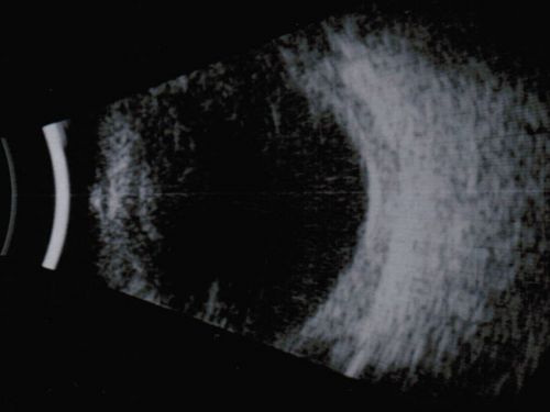 Nanopthalmous (Microphthalmous) Chorioretinal Folds and Choroidal Thickening Both Eyes B-Scan Ultrasound
