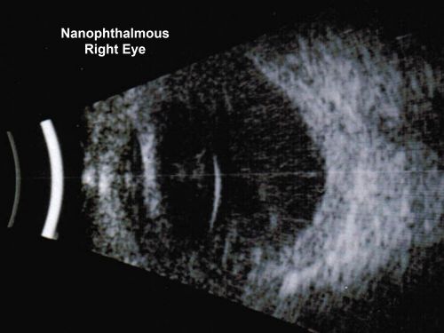 Nanopthalmous (Microphthalmous) Chorioretinal Folds and Choroidal Thickening Both Eyes B-Scan Ultrasound
