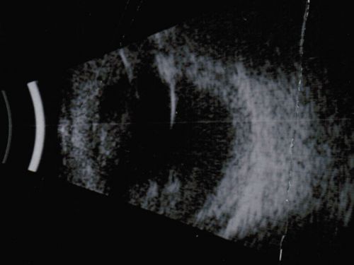 Nanopthalmous (Microphthalmous) Chorioretinal Folds and Choroidal Thickening Both Eyes B-Scan Ultrasound
