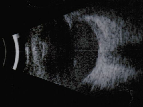 Nanopthalmous (Microphthalmous) Chorioretinal Folds and Choroidal Thickening Both Eyes B-Scan Ultrasound
