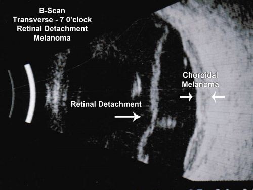Choroidal Melanoma - Exudative Retinal Detachment 82 Year Old Man B Scan - Transverse
82-year-old man who had 3 falls 2 weeks ago. After the falls he started checking his vision and noticed there was a veil over the left eye, which he had seen for about two weeks in the superior visual field.  OD 20/25,  OS 20/40
(patient was medically never well enough for brachytherapy and died 6 months later from heart disease) 
