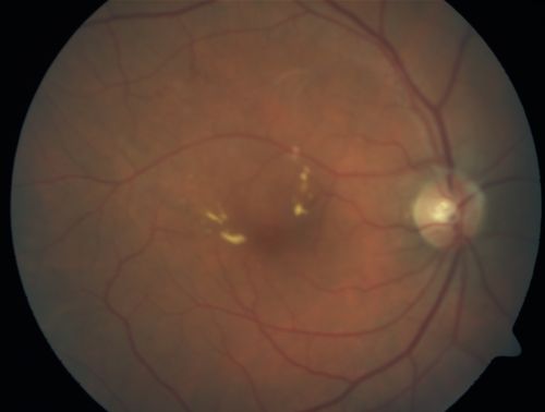 BRVO with collaterals and cystoid macular edema
66 Year Old Man with has had a branch retinal vein occlusion in the right eye with vision loss for the last few months.  OD is 20/40, OS is 20/20.  IOP:  OD 18, OS 19.  There is a superotemporal macular branch retinal vein occlusion with edema, hemorrhage, and exudate.
OCT SCAN:  The right eye shows edema with a central foveal thickness of 354 microns FA: shows remodeling of the superotemporal vasculature.  There are already venous-venous collaterals, suggesting the vein occlusion may be a little more than a few months old.  There are multiple microaneurysms superotemporal to the fovea, and there is leakage in the late frames involving the fovea.

Keywords: brvo;cme;cystoid macular edema;collaterals