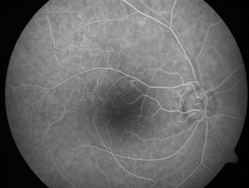 BRVO with collaterals and cystoid macular edema
66 Year Old Man with has had a branch retinal vein occlusion in the right eye with vision loss for the last few months.  OD is 20/40, OS is 20/20.  IOP:  OD 18, OS 19.  There is a superotemporal macular branch retinal vein occlusion with edema, hemorrhage, and exudate.
OCT SCAN:  The right eye shows edema with a central foveal thickness of 354 microns FA: shows remodeling of the superotemporal vasculature.  There are already venous-venous collaterals, suggesting the vein occlusion may be a little more than a few months old.  There are multiple microaneurysms superotemporal to the fovea, and there is leakage in the late frames involving the fovea.

Keywords: brvo;cme;cystoid macular edema;collaterals