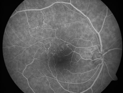 BRVO with collaterals and cystoid macular edema
66 Year Old Man with has had a branch retinal vein occlusion in the right eye with vision loss for the last few months.  OD is 20/40, OS is 20/20.  IOP:  OD 18, OS 19.  There is a superotemporal macular branch retinal vein occlusion with edema, hemorrhage, and exudate.
OCT SCAN:  The right eye shows edema with a central foveal thickness of 354 microns FA: shows remodeling of the superotemporal vasculature.  There are already venous-venous collaterals, suggesting the vein occlusion may be a little more than a few months old.  There are multiple microaneurysms superotemporal to the fovea, and there is leakage in the late frames involving the fovea.

Keywords: brvo;cme;cystoid macular edema;collaterals
