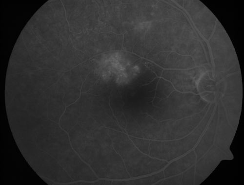 BRVO with collaterals and cystoid macular edema
66 Year Old Man with has had a branch retinal vein occlusion in the right eye with vision loss for the last few months.  OD is 20/40, OS is 20/20.  IOP:  OD 18, OS 19.  There is a superotemporal macular branch retinal vein occlusion with edema, hemorrhage, and exudate.
OCT SCAN:  The right eye shows edema with a central foveal thickness of 354 microns FA: shows remodeling of the superotemporal vasculature.  There are already venous-venous collaterals, suggesting the vein occlusion may be a little more than a few months old.  There are multiple microaneurysms superotemporal to the fovea, and there is leakage in the late frames involving the fovea.

Keywords: brvo;cme;cystoid macular edema;collaterals