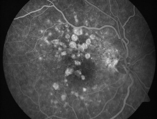 Calcified Drusen - Dry Age-related Macular Degeneration - Geographic Atrophy
87 Year old woman with dry age-related macular degeneration in both eyes.With both eyes open she is fine, but when she closes the left eye, things are wavier.

VISUAL ACUITY:  Vision OD is 20/100, OS is 20/40.

