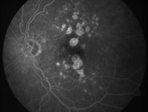 Calcified Drusen - Dry Age-related Macular Degeneration - Geographic Atrophy
87 Year old woman with dry age-related macular degeneration in both eyes.With both eyes open she is fine, but when she closes the left eye, things are wavier.

VISUAL ACUITY:  Vision OD is 20/100, OS is 20/40.
