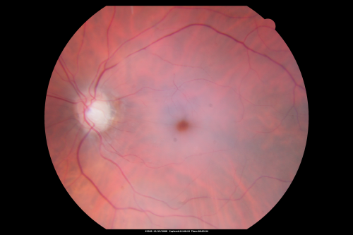 Central Retinal Artery Occlusion less than 24 hours - 69 year old man VA light perception
