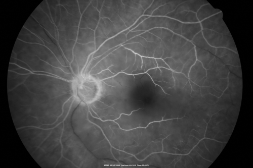 Keywords: Central Retinal Artery Occlusion less than 24 hours - 69 year old man VA light perception