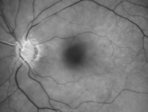 Central Retinal Artery Occlusion less than 24 hours - 69 year old man VA light perception
