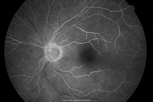 Central Retinal Artery Occlusion less than 24 hours - 69 year old man VA light perception
