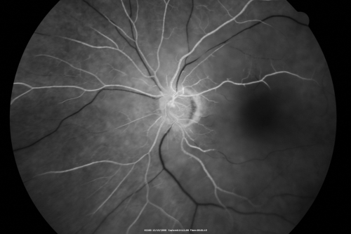 Central Retinal Artery Occlusion less than 24 hours - 69 year old man VA light perception

