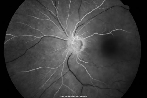 Central Retinal Artery Occlusion less than 24 hours - 69 year old man VA light perception
