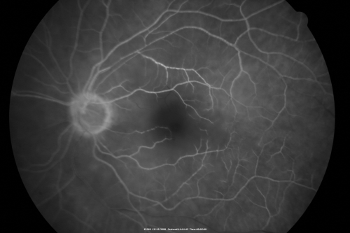 Central Retinal Artery Occlusion less than 24 hours - 69 year old man VA light perception
