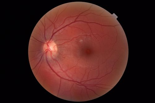 Cat Scratch - Neuroretinitis OD AND retinitis OS - Bartonella henselae positive
27 year old female with exposure to cats and prior fever.  Reports with recent vision loss right eye.  She was treated with doxycycline and within 2 weeks the right eye looks better.  Then she skipped all follow-up visits.  The right eye presented 20/200 and the left 20/16
