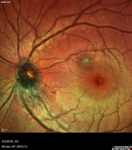 Cat Scratch - Neuroretinitis OD AND retinitis OS - Bartonella henselae positive
27 year old female with exposure to cats and prior fever.  Reports with recent vision loss right eye.  She was treated with doxycycline and within 2 weeks the right eye looks better.  Then she skipped all follow-up visits.  The right eye presented 20/200 and the left 20/16
