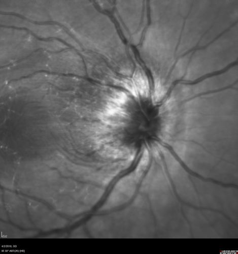 Cat Scratch - Neuroretinitis OD AND retinitis OS - Bartonella henselae positive
27 year old female with exposure to cats and prior fever.  Reports with recent vision loss right eye.  She was treated with doxycycline and within 2 weeks the right eye looks better.  Then she skipped all follow-up visits.  The right eye presented 20/200 and the left 20/16
